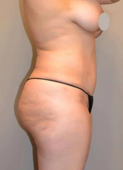 Brazilian Butt Lift With Fat Transfer Before & After Case 3937