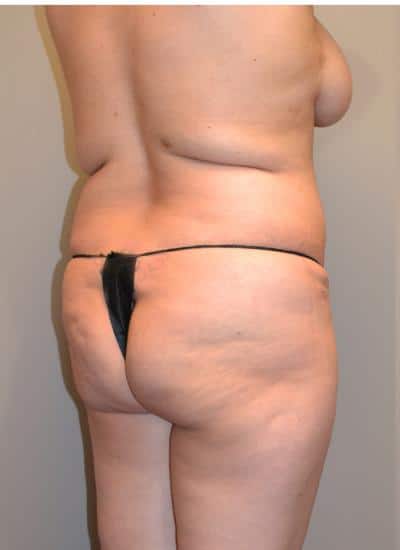 Brazilian Butt Lift With Fat Transfer Before & After Case 3937