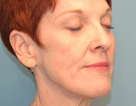 CO2 Laser Resurfacing Before & After Case 5365