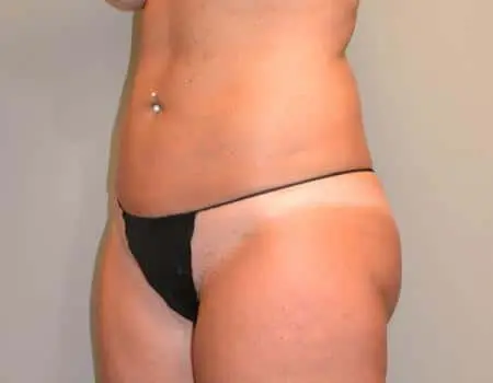 Smartlipo Before & After Case 4235