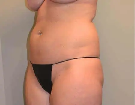 Smartlipo Before & After Case 4235