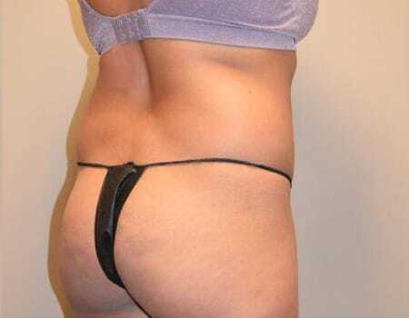 Smartlipo Before & After Case 4211
