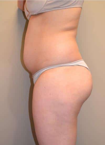 Smartlipo Before & After Case 4200