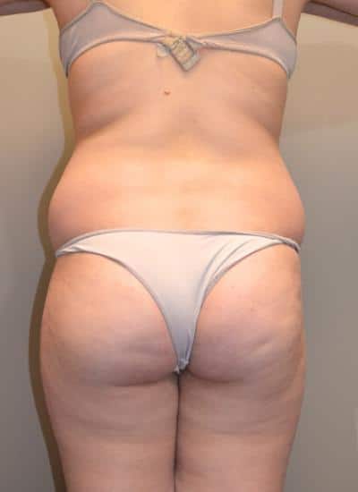 Smartlipo Before & After Case 4200