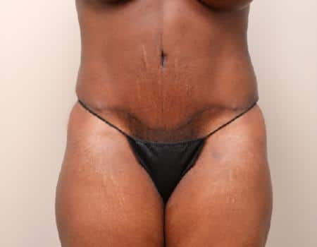 Tummy Tuck Before & After Case 3800