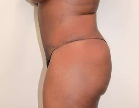 Tummy Tuck Before & After Case 3800