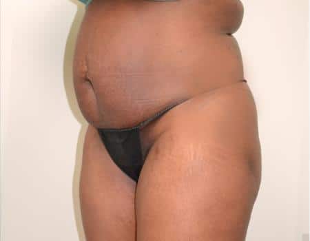 Tummy Tuck Before & After Case 3800