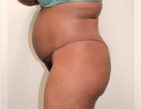 Tummy Tuck Before & After Case 3800