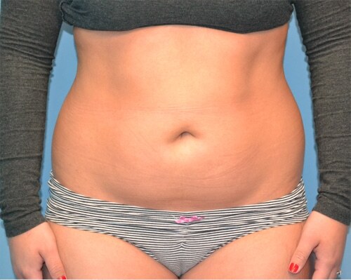 Smartlipo Before & After Case 4355
