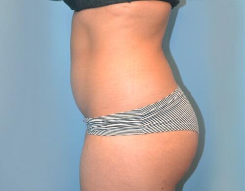 Smartlipo Before & After Case 4355