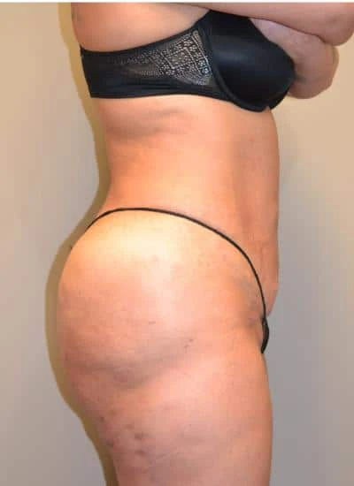 Brazilian Butt Lift With Fat Transfer Before & After Case 3950