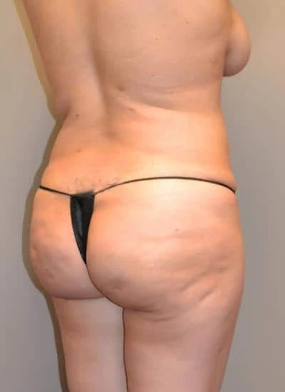 Brazilian Butt Lift With Fat Transfer Before & After Case 3937