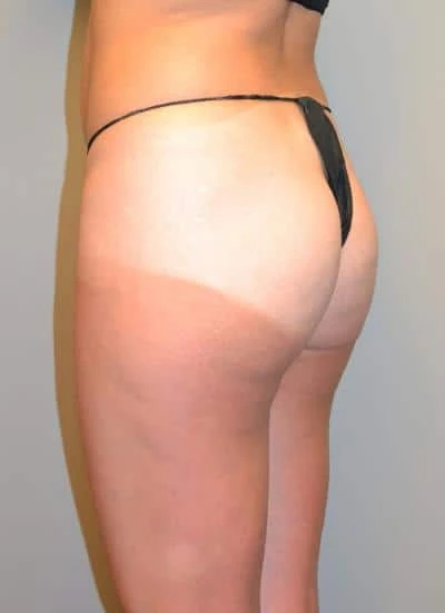 Brazilian Butt Lift With Fat Transfer Before & After Case 3874