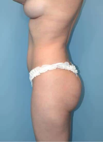 Brazilian Butt Lift With Fat Transfer Before & After Case 3964