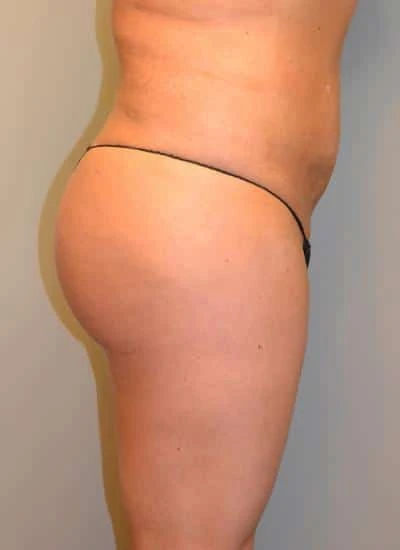 Brazilian Butt Lift With Fat Transfer Before & After Case 4014