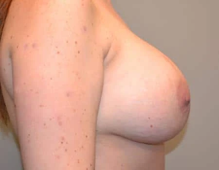Breast Augmentation Before & After Case 4415