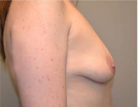 Breast Augmentation Before & After Case 4415