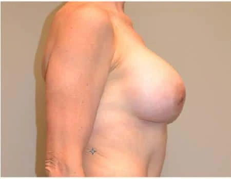 Breast Augmentation Before & After Case 4383