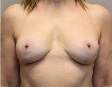Breast Lift Before & After Case 4751