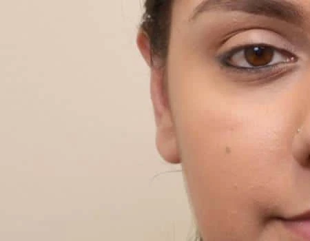 Ear Surgery (Otoplasty) Before & After Case 5116
