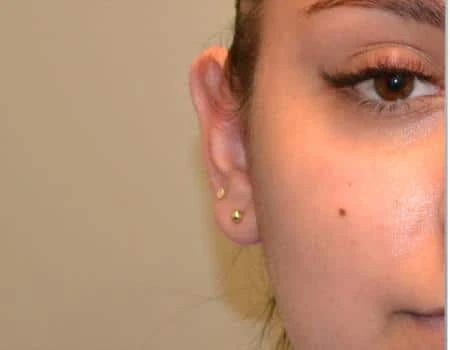 Ear Surgery (Otoplasty) Before & After Case 5116