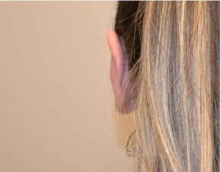 Ear Surgery (Otoplasty) Before & After Case 5116