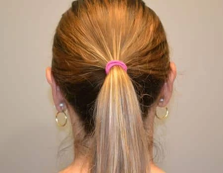 Ear Surgery (Otoplasty) Before & After Case 5094