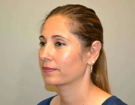 Ear Surgery (Otoplasty) Before & After Case 5094