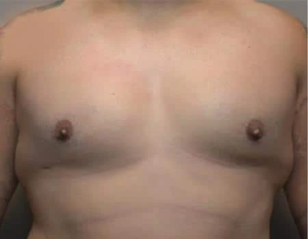 Gynecomastia Before & After Case 4886