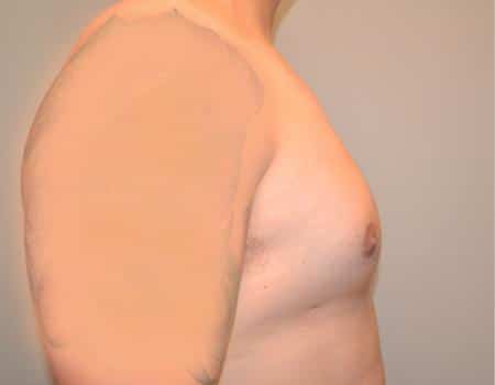 Gynecomastia Before & After Case 4886