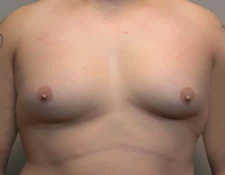 Gynecomastia Before & After Case 4886