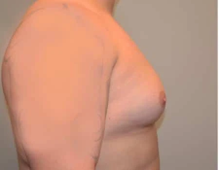Gynecomastia Before & After Case 4886