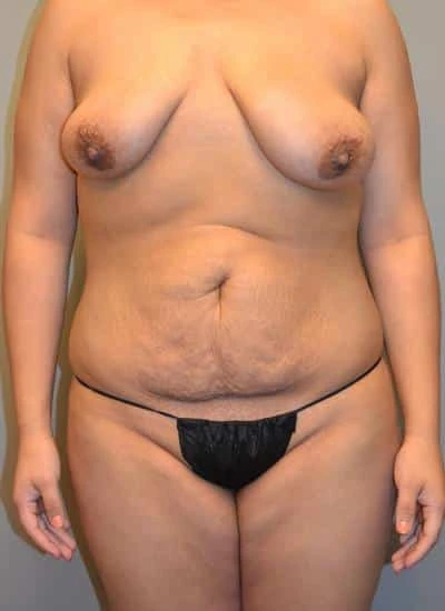 MommyMakeover_01_b1