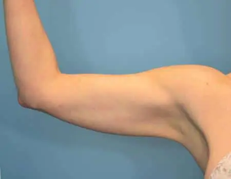 Smartlipo Before & After Case 4286