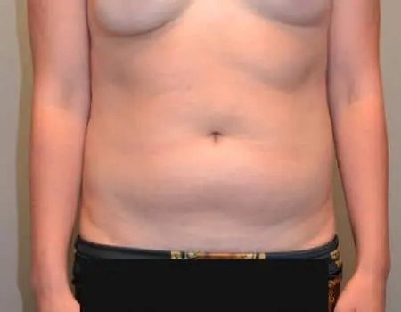 SMART-LIPO-C12-B1