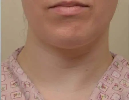 Smartlipo Before & After Case 4272