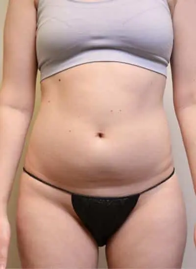 SMART-LIPO-C14-B1