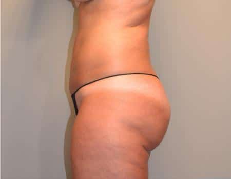 Smartlipo Before & After Case 4235