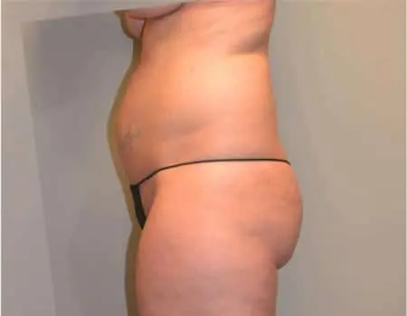 SMART-LIPO-C17-B1