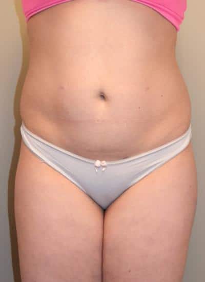 Smartlipo Before & After Case 4200