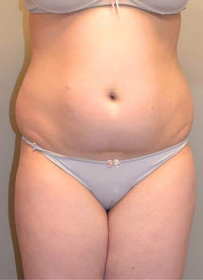 SMART-LIPO-C21-B1
