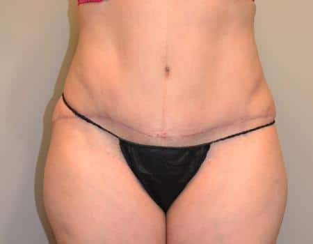 SMART-LIPO-C22-B1