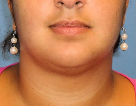 Smart Lipo Before & After Before & After Case 4184