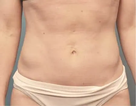 Smartlipo Before & After Case 4158