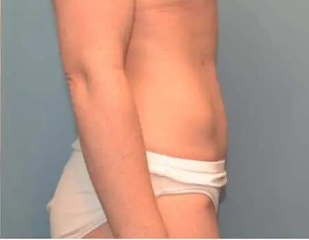 Smartlipo Before & After Case 4158