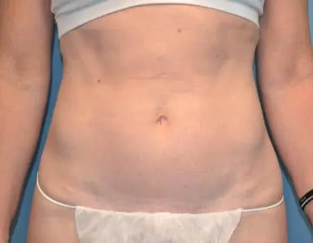 Smartlipo Before & After Case 4158
