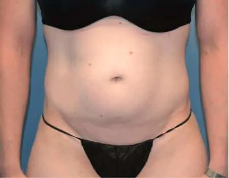 SMART-LIPO-C28-B1