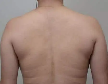 SMART-LIPO-C5-B1