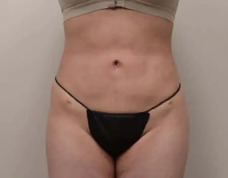 Smartlipo Before & After Case 4309