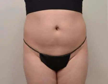 SMART-LIPO-C8-B1
